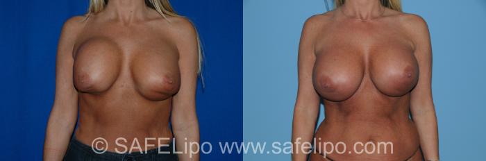 Implant Exchange Front Photo, Shreveport, Louisiana, The Wall Center for Plastic Surgery, Case 273