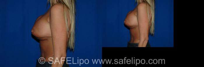 Implant Exchange Left Side Photo, Shreveport, LA, The Wall Center for Plastic Surgery, Case 273