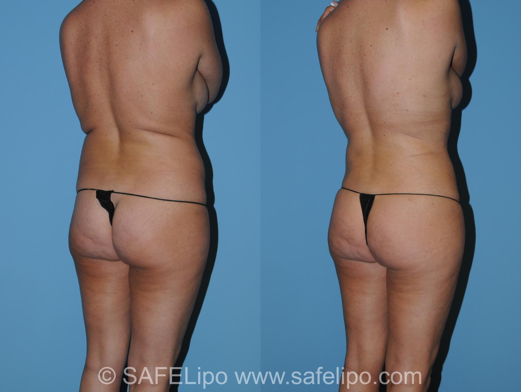 SAFELipo Back Right Oblique Photo, Shreveport, LA, The Wall Center for Plastic Surgery, Case 340