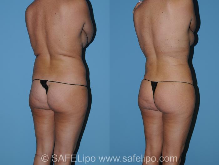 SAFELipo Back Right Oblique Photo, Shreveport, LA, The Wall Center for Plastic Surgery, Case 340