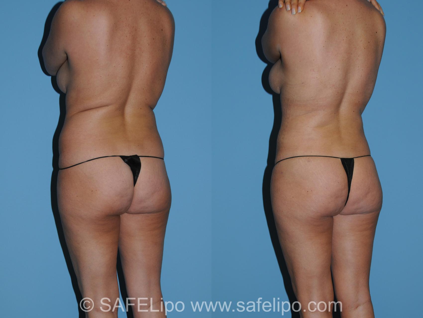 SAFELipoHD® Case 340 Before & After View #6 | SAFELipo®
