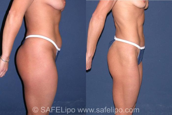 SAFELipoHD® Case 7 Before & After View #3 | SAFELipo®