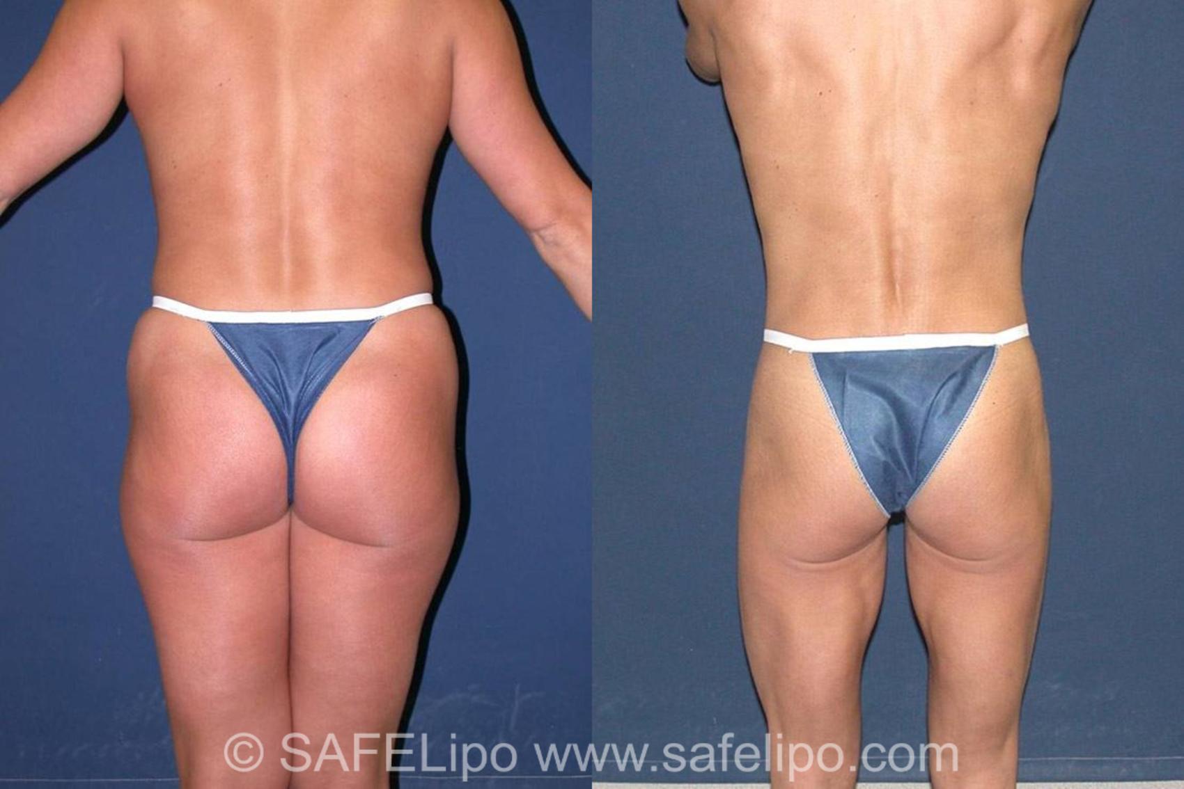 SAFELipoHD® Case 7 Before & After View #4 | SAFELipo®