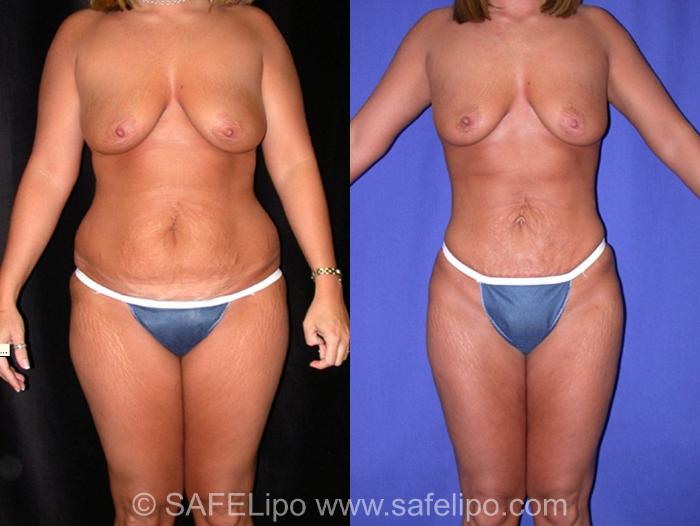 SAFELipoHD® Case 8 Before & After View #1 | SAFELipo®