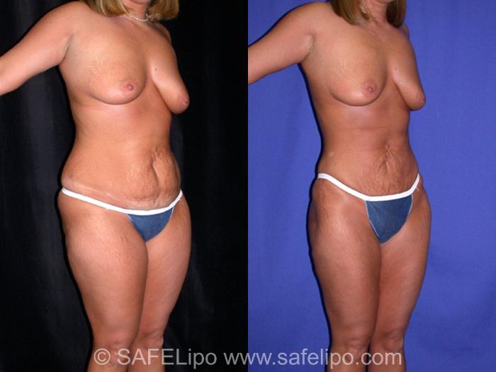 SAFELipoHD® Case 8 Before & After View #2 | SAFELipo®