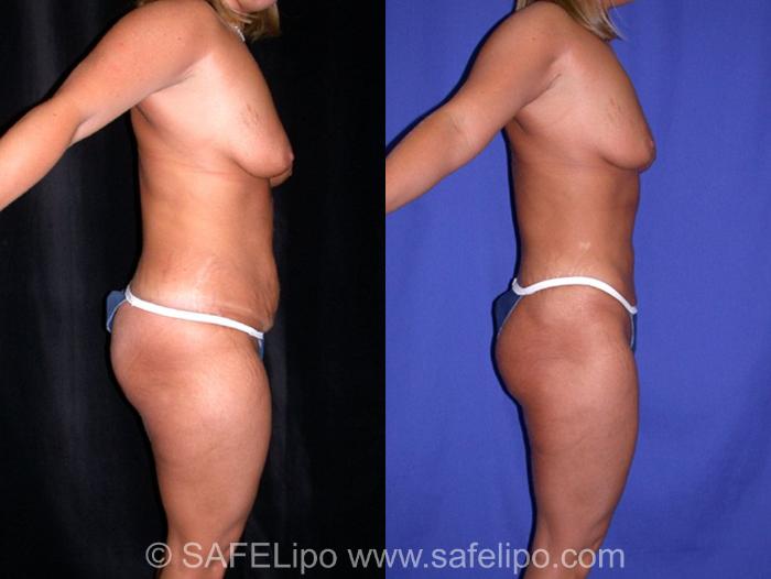 SAFELipoHD® Case 8 Before & After View #3 | SAFELipo®