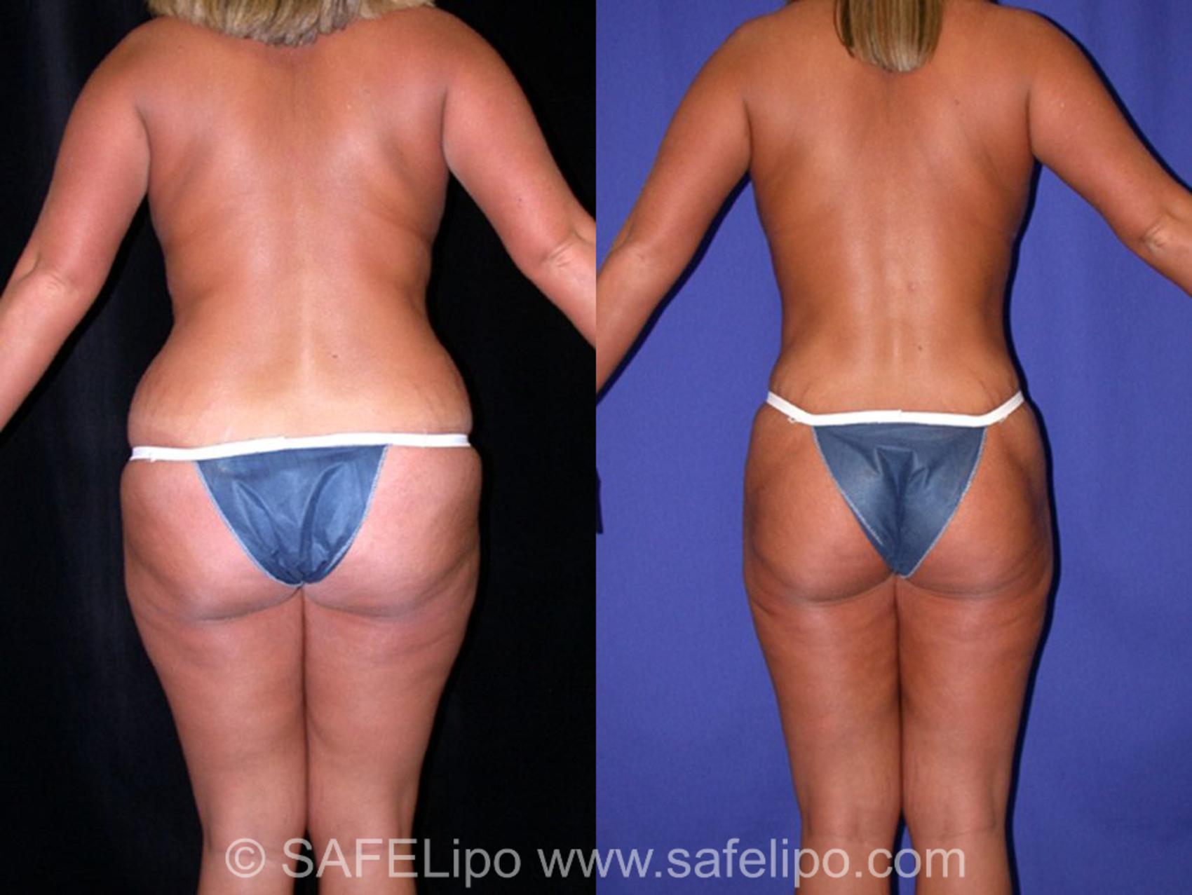 SAFELipoHD® Case 8 Before & After View #4 | SAFELipo®
