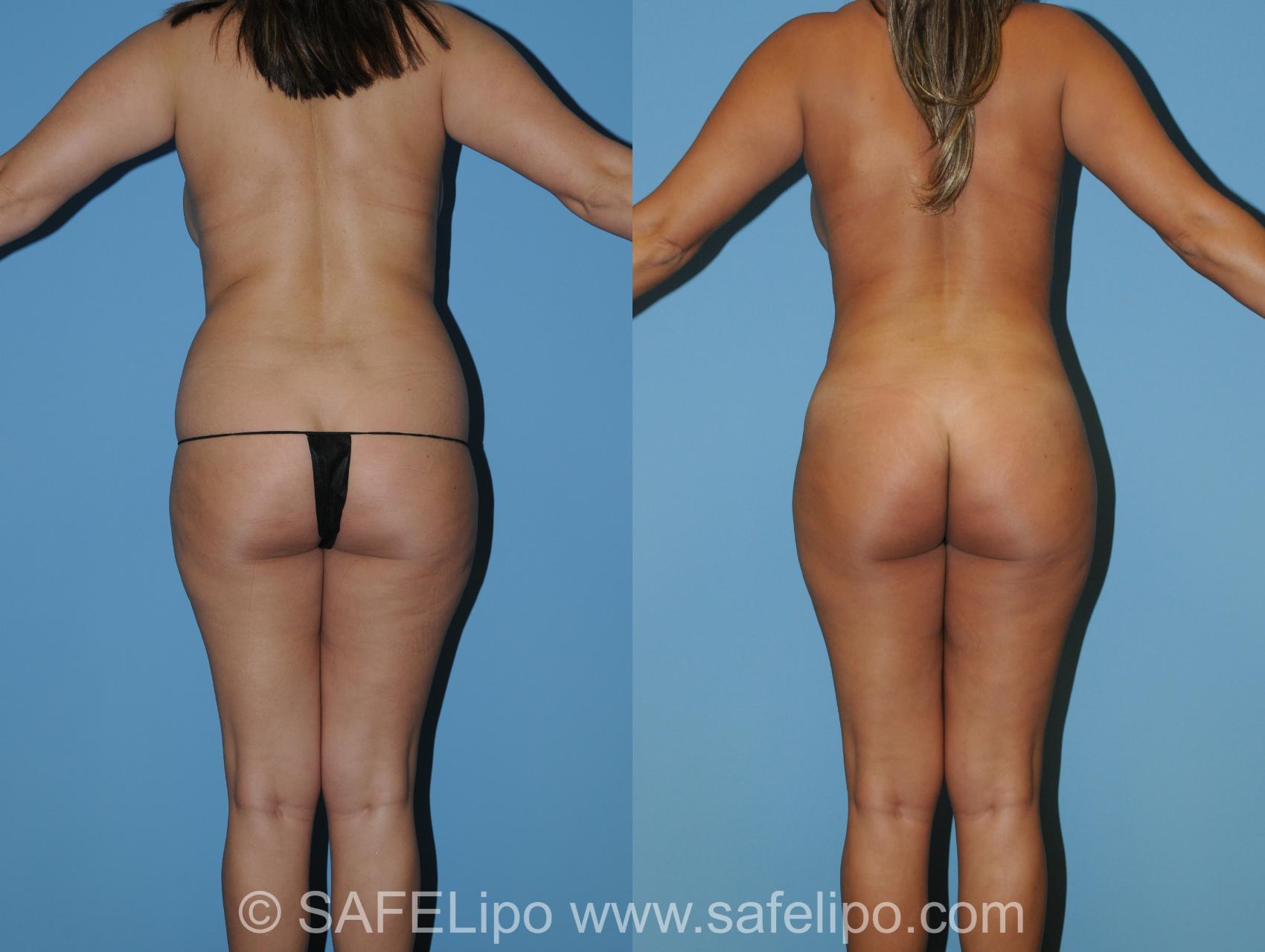 Abdominoplasty Back Photo, Shreveport, LA, The Wall Center for Plastic Surgery, Case 275