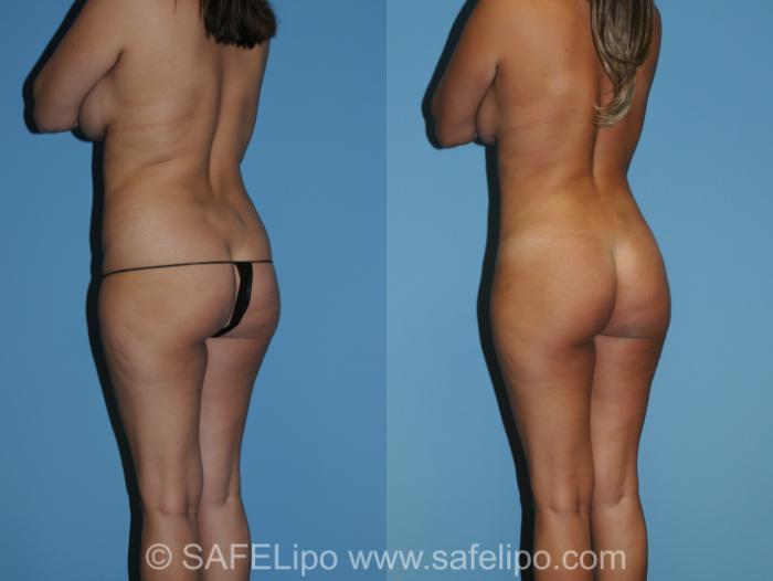 Abdominoplasty Back L Oblique Photo, Shreveport, LA, The Wall Center for Plastic Surgery, Case 275