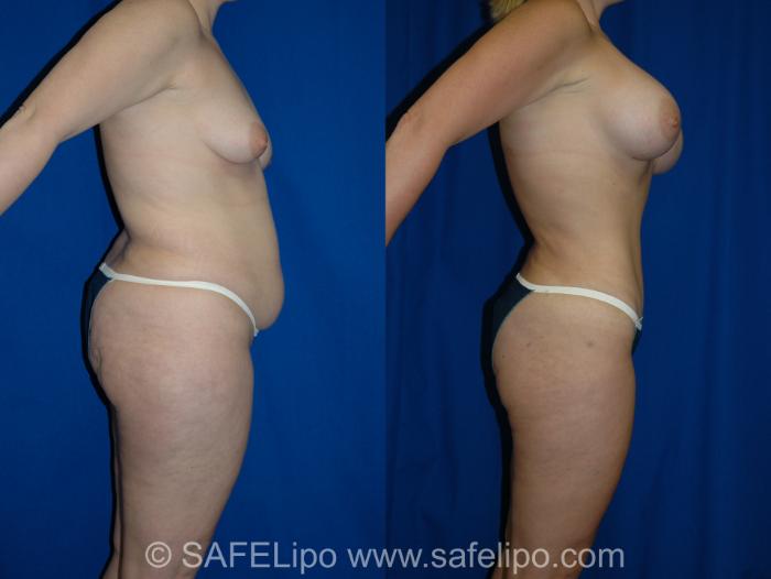 Abdominoplasty Right Side Photo, Shreveport, LA, The Wall Center for Plastic Surgery, Case 277