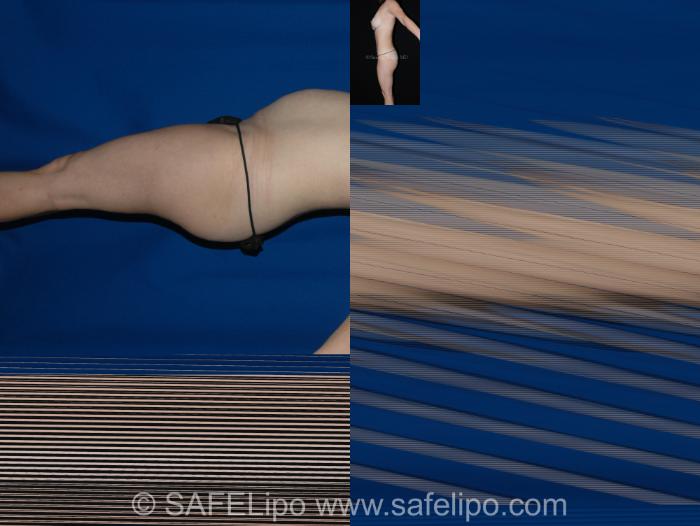 Abdominoplasty Left Side Photo, Shreveport, LA, The Wall Center for Plastic Surgery, Case 278