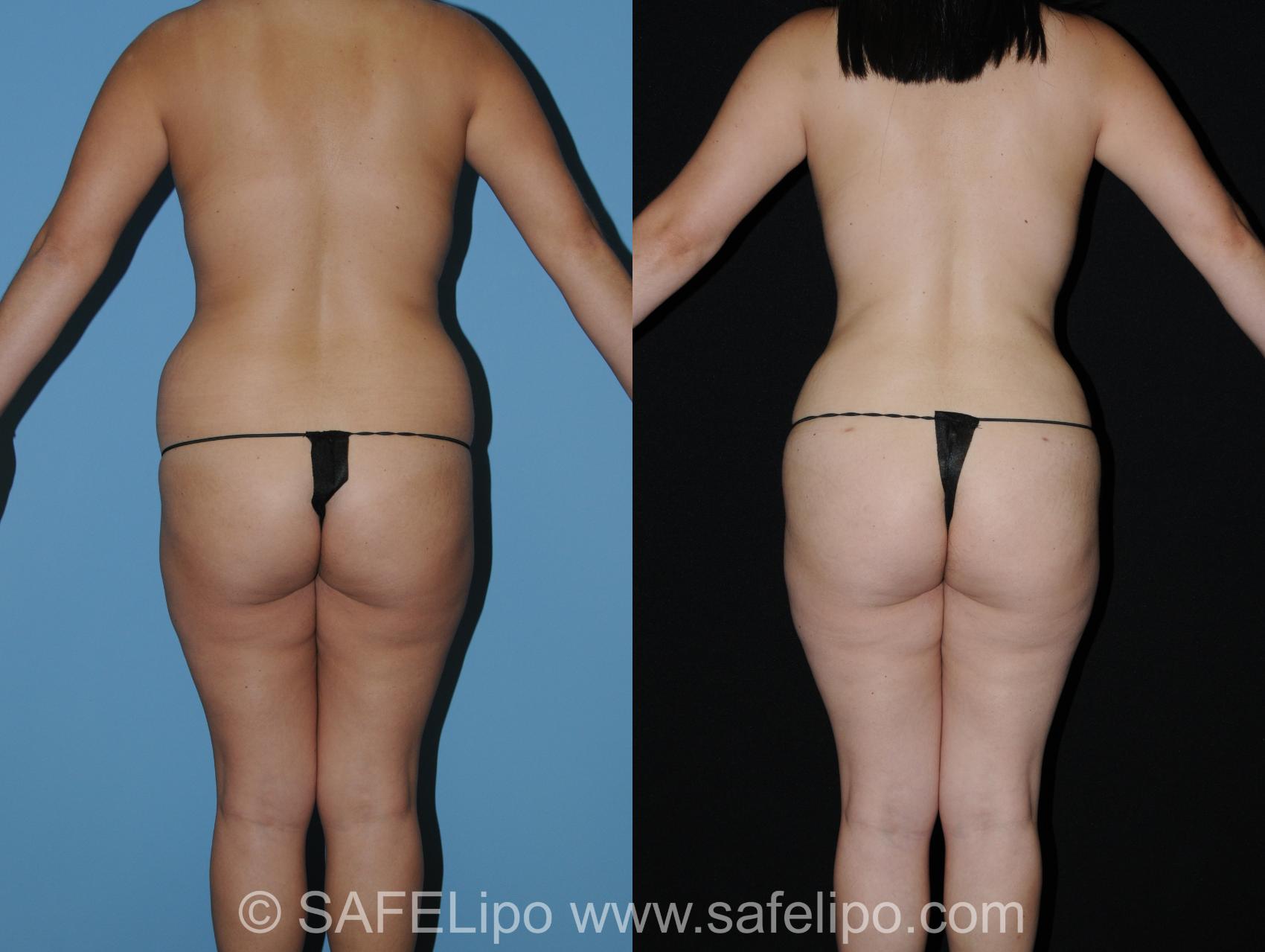 Abdominoplasty Back Photo, Shreveport, Louisiana, The Wall Center for Plastic Surgery, Case 280