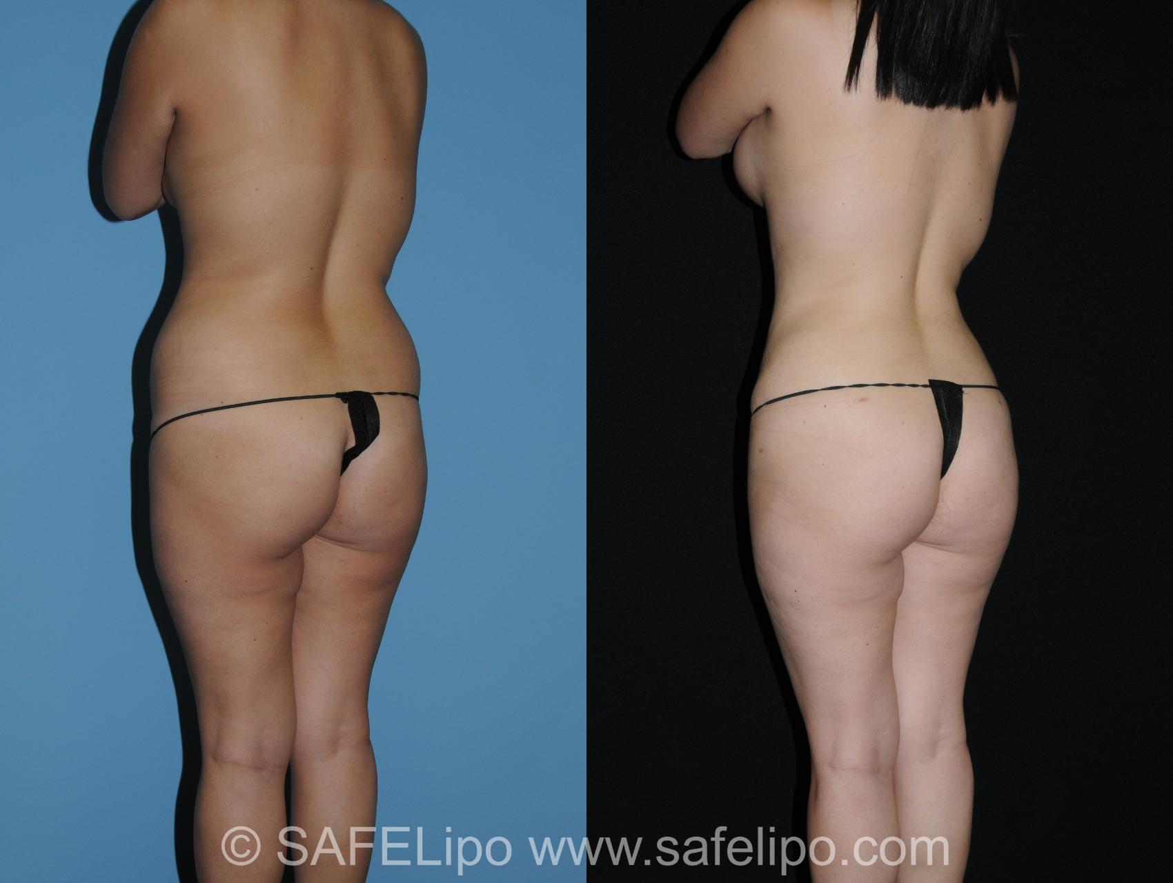 Abdominoplasty Back L Oblique Photo, Shreveport, LA, The Wall Center for Plastic Surgery, Case 280