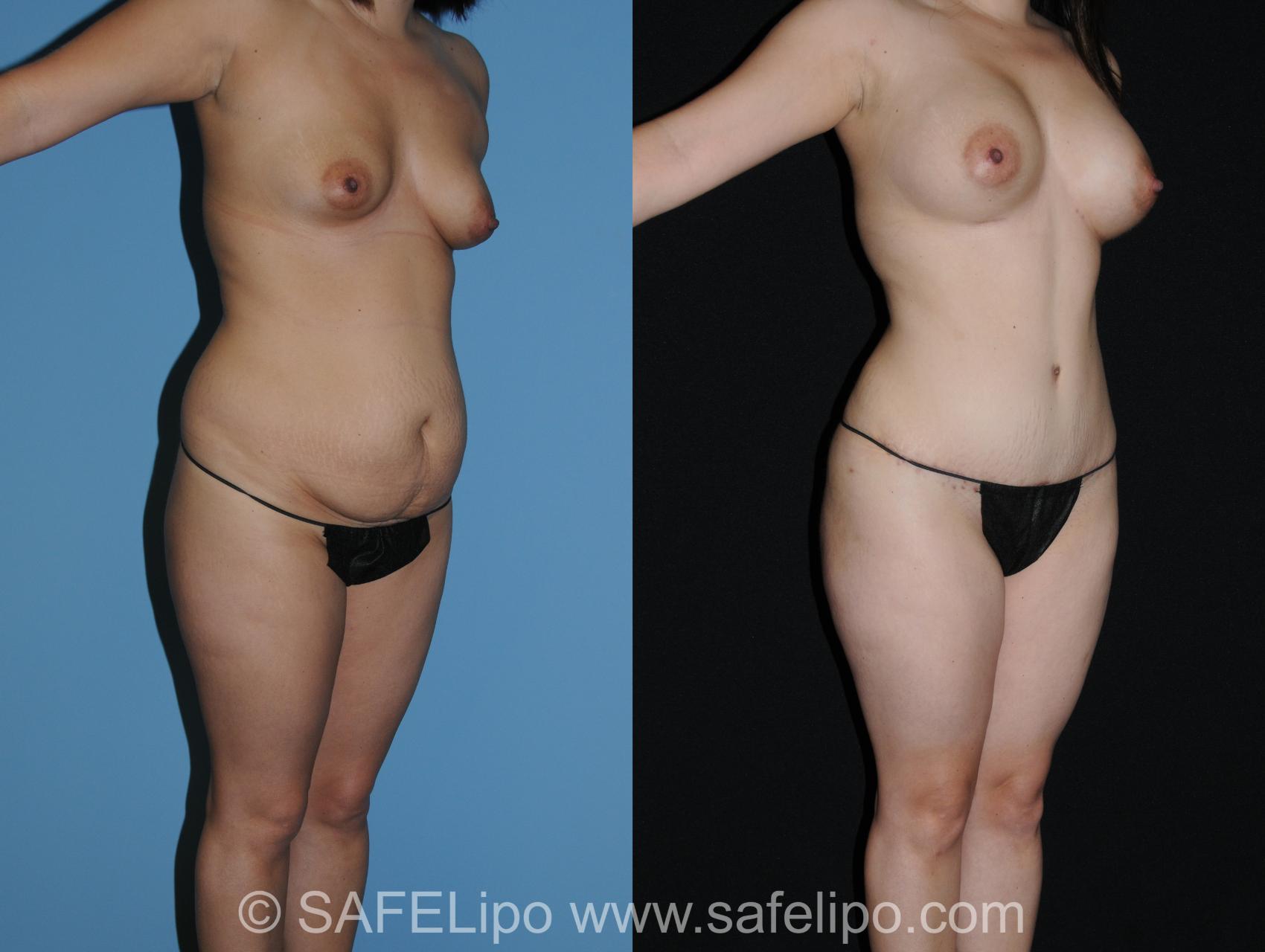 Abdominoplasty Right Oblique Photo, Shreveport, LA, The Wall Center for Plastic Surgery, Case 280