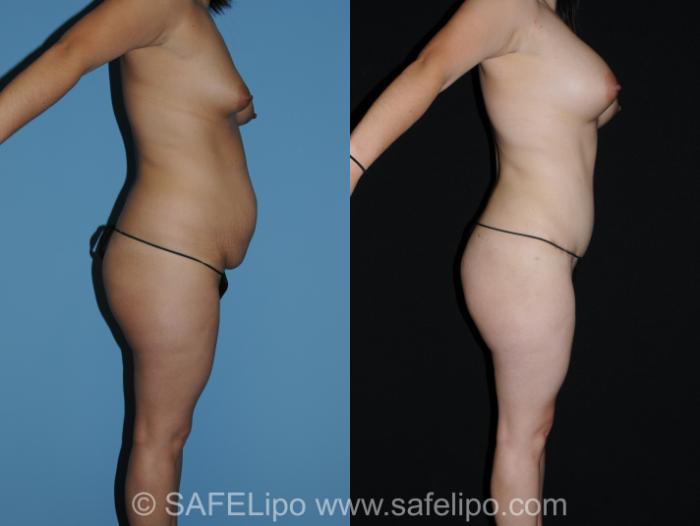 Abdominoplasty Right Side Photo, Shreveport, LA, The Wall Center for Plastic Surgery, Case 280