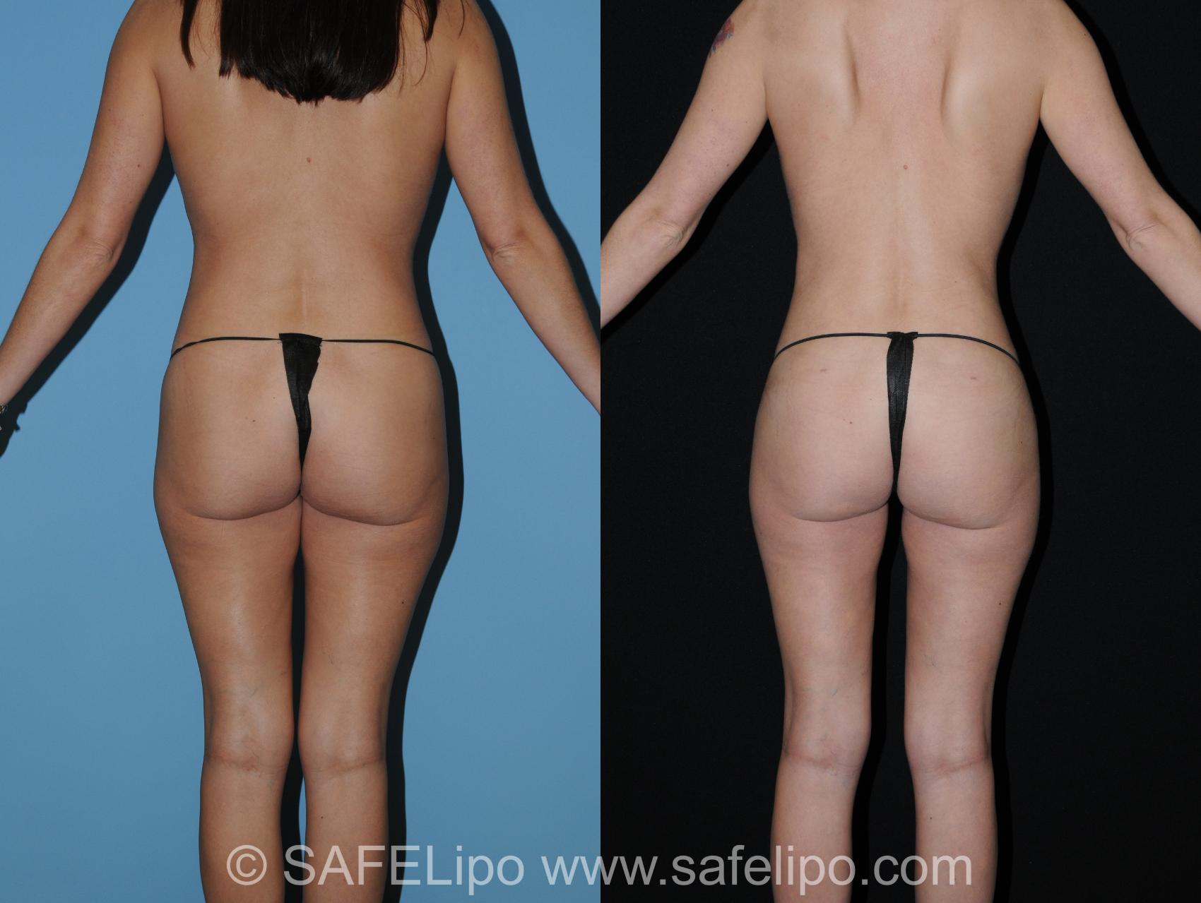Abdominoplasty Back Photo, Shreveport, Louisiana, The Wall Center for Plastic Surgery, Case 280