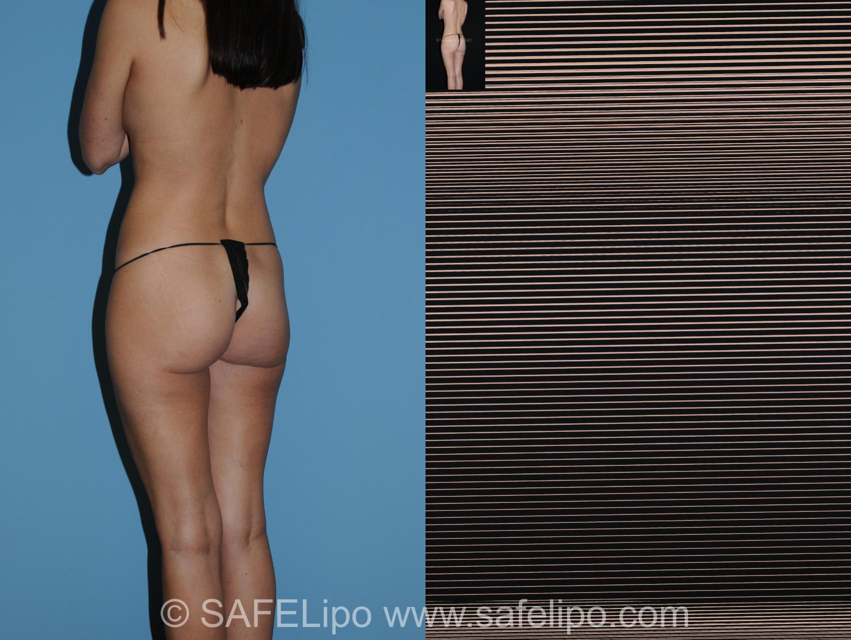 Abdominoplasty Back L Oblique Photo, Shreveport, LA, The Wall Center for Plastic Surgery, Case 280