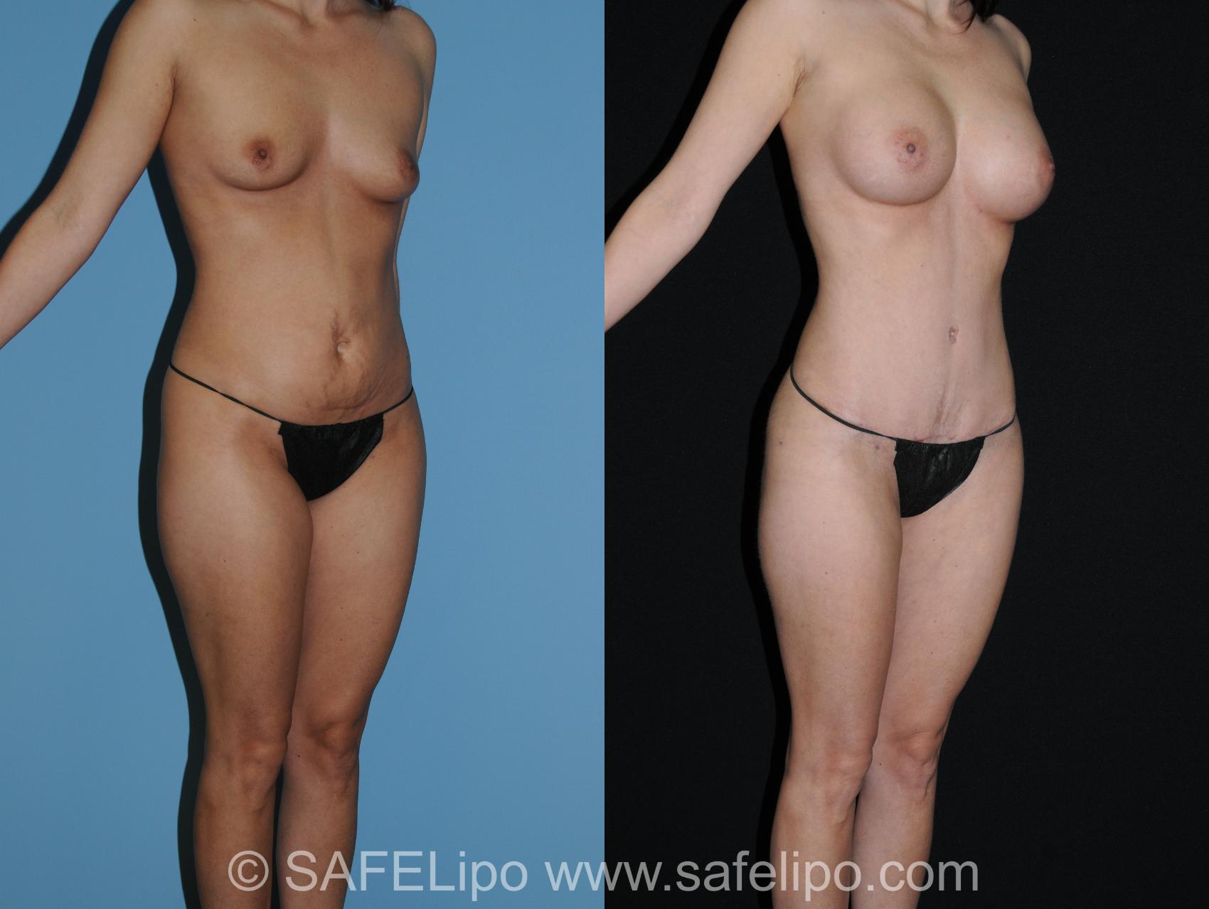 Abdominoplasty Right Oblique Photo, Shreveport, LA, The Wall Center for Plastic Surgery, Case 280
