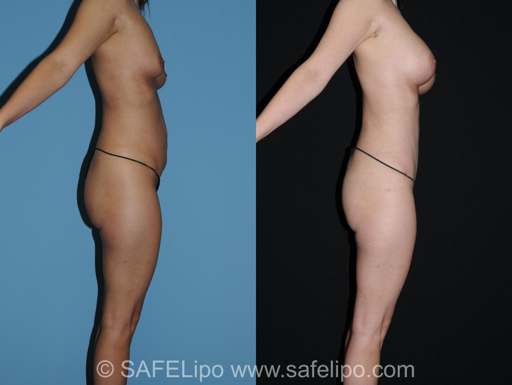 Abdominoplasty Right Side Photo, Shreveport, LA, The Wall Center for Plastic Surgery, Case 280