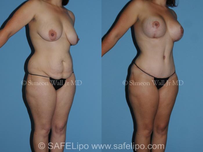 Tummy Tuck Case 282 Before & After View #2 | SAFELipo®