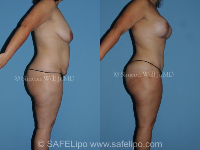 Tummy Tuck Case 282 Before & After View #3 | SAFELipo®