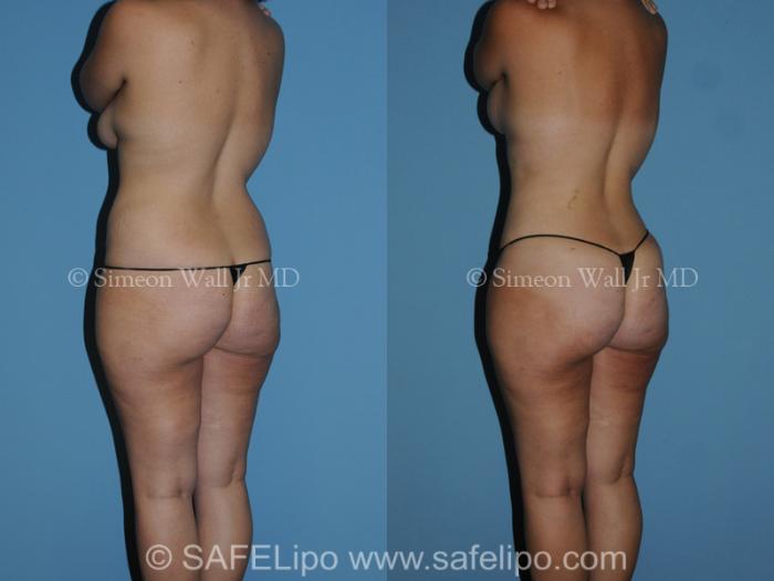 SAFELipoHD® Case 282 Before & After View #4 | SAFELipo®