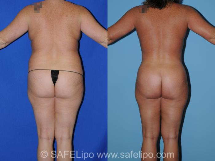 Abdominoplasty Back Photo, Shreveport, Louisiana, The Wall Center for Plastic Surgery, Case 283