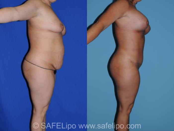 Abdominoplasty Right Side Photo, Shreveport, LA, The Wall Center for Plastic Surgery, Case 280