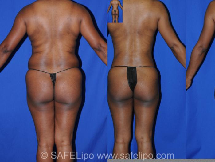 Abdominoplasty Back Photo, Shreveport, Louisiana, The Wall Center for Plastic Surgery, Case 285