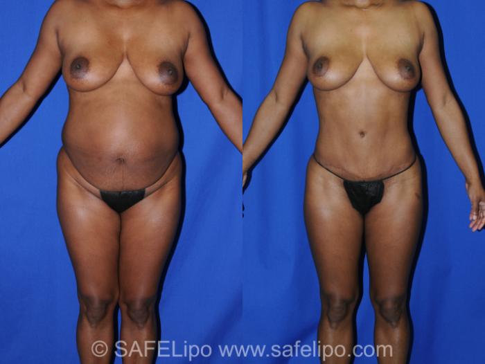Abdominoplasty Front Photo, Shreveport, Louisiana, The Wall Center for Plastic Surgery, Case 285