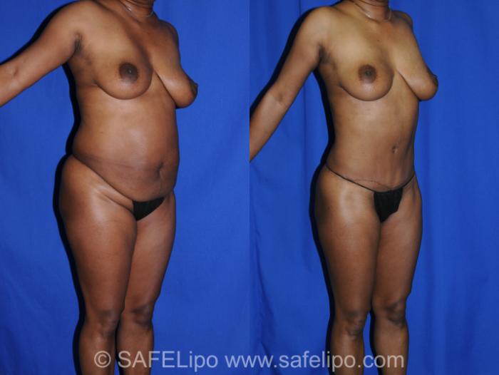 Abdominoplasty Right Oblique Photo, Shreveport, LA, The Wall Center for Plastic Surgery, Case 285