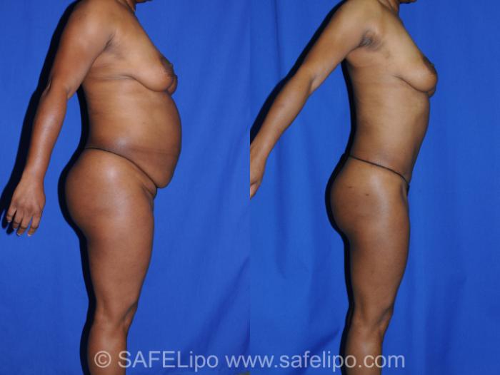 Abdominoplasty Right Side Photo, Shreveport, LA, The Wall Center for Plastic Surgery, Case 285