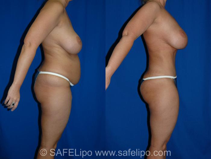 Abdominoplasty Right Side Photo, Shreveport, LA, The Wall Center for Plastic Surgery, Case 286