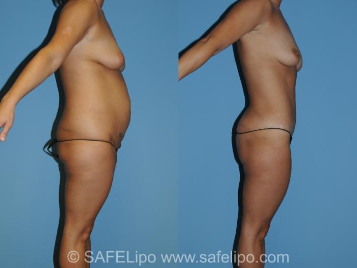 Abdominoplasty Right Side Photo, Shreveport, LA, The Wall Center for Plastic Surgery, Case 287