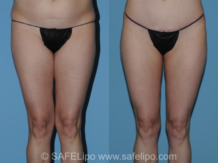 Abdominoplasty Front Thighs Photo, Shreveport, LA, The Wall Center for Plastic Surgery, Case 288