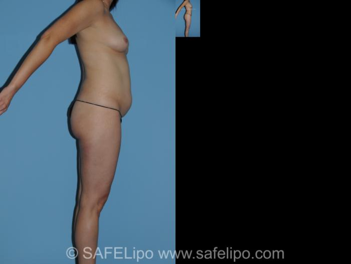 Abdominoplasty Right Side Photo, Shreveport, LA, The Wall Center for Plastic Surgery, Case 288