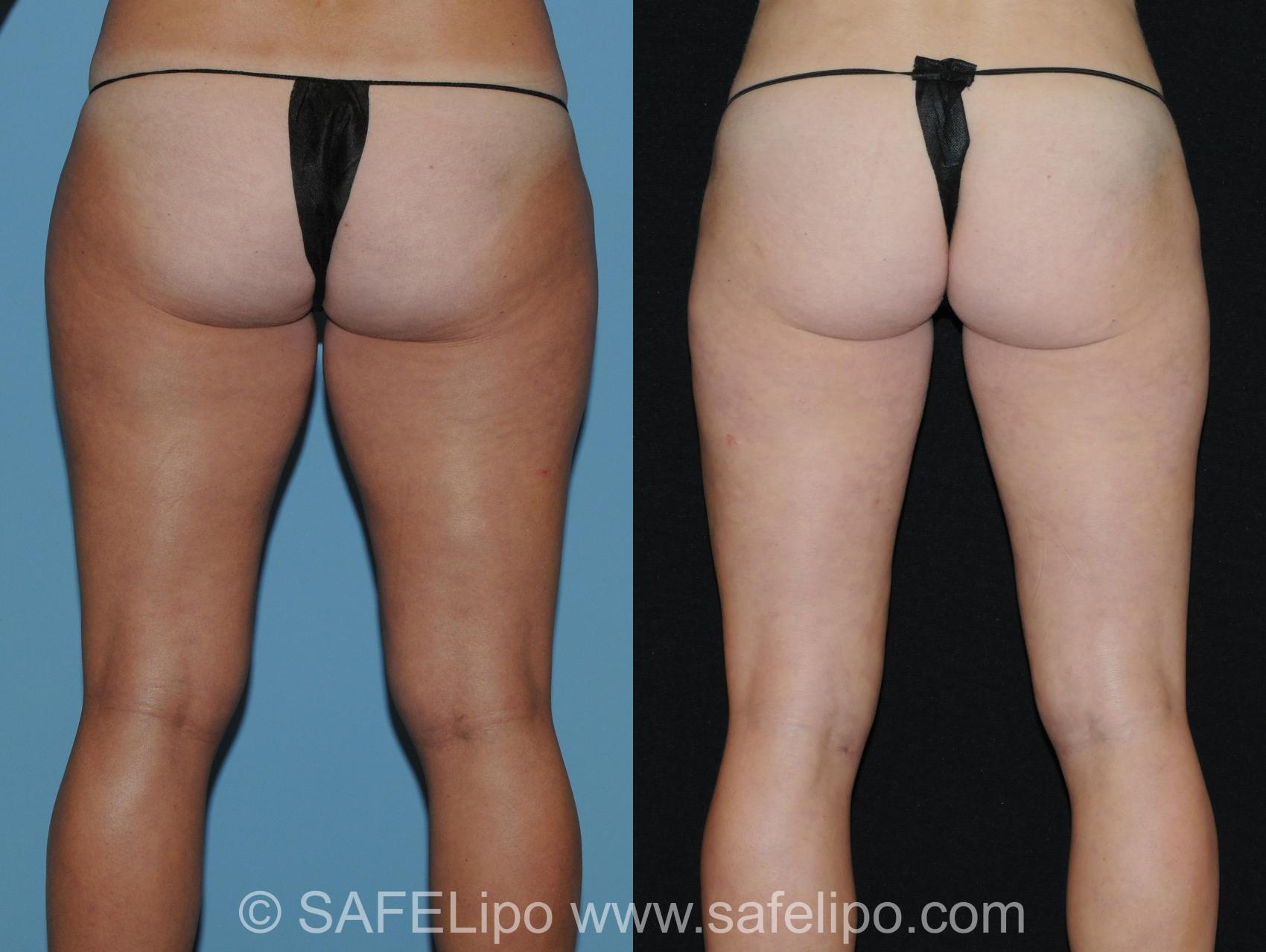 Abdominoplasty Back Thighs Photo, Shreveport, LA, The Wall Center for Plastic Surgery, Case 289
