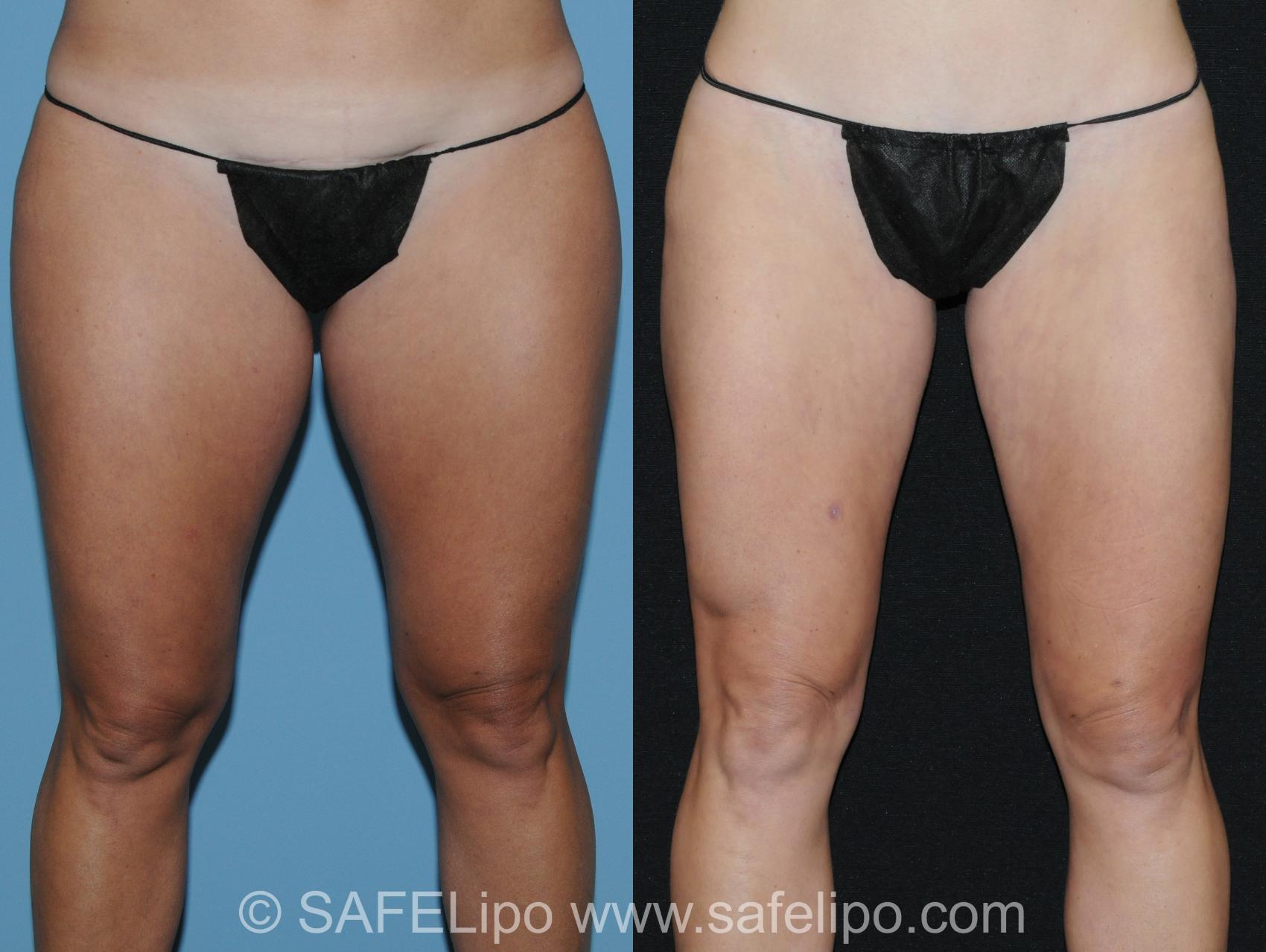 Abdominoplasty Front Thigh Photo, Shreveport, LA, The Wall Center for Plastic Surgery, Case 289