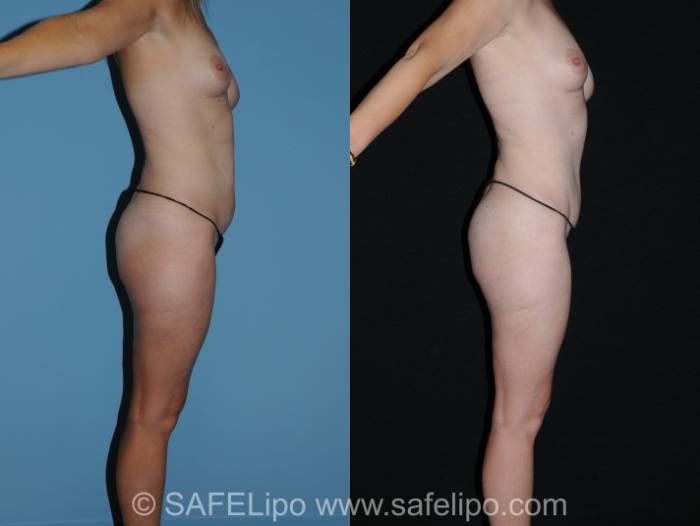 Abdominoplasty Right Side Photo, Shreveport, LA, The Wall Center for Plastic Surgery, Case 290