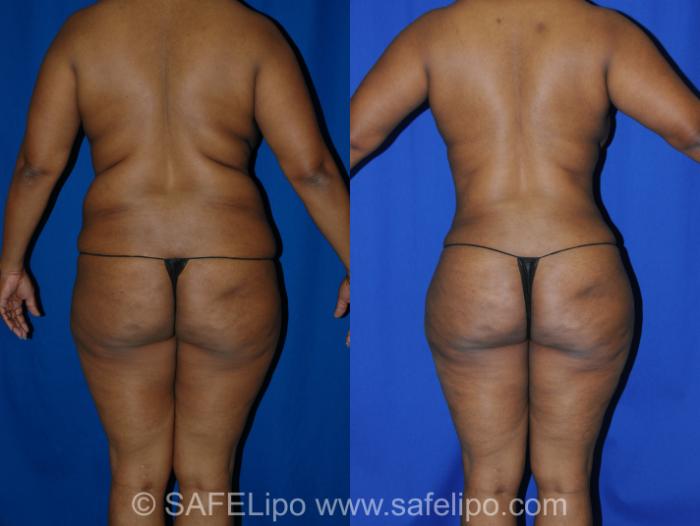 Abdominoplasty Back Photo, Shreveport, Louisiana, The Wall Center for Plastic Surgery, Case 291
