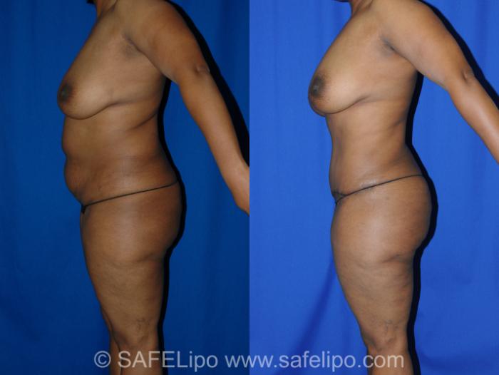 Abdominoplasty Left Side Photo, Shreveport, LA, The Wall Center for Plastic Surgery, Case 291