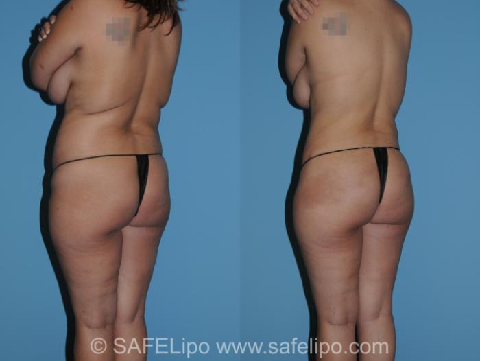 Abdominoplasty Back L Oblique Photo, Shreveport, LA, The Wall Center for Plastic Surgery, Case 292