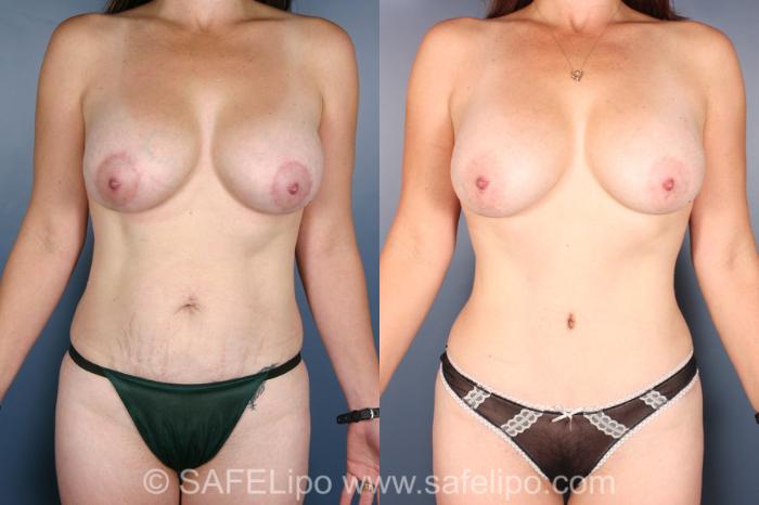 SAFELipo®360 Case 300 Before & After View #1 | SAFELipo®