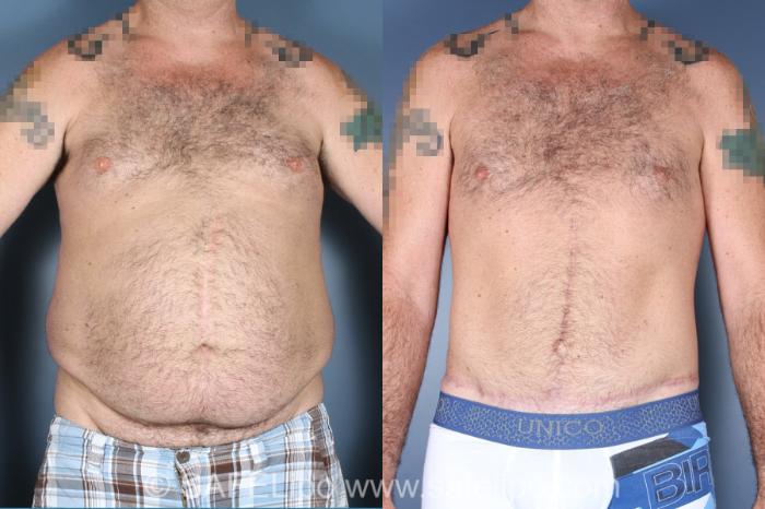 Tummy Tuck Case 303 Before & After View #1 | SAFELipo®