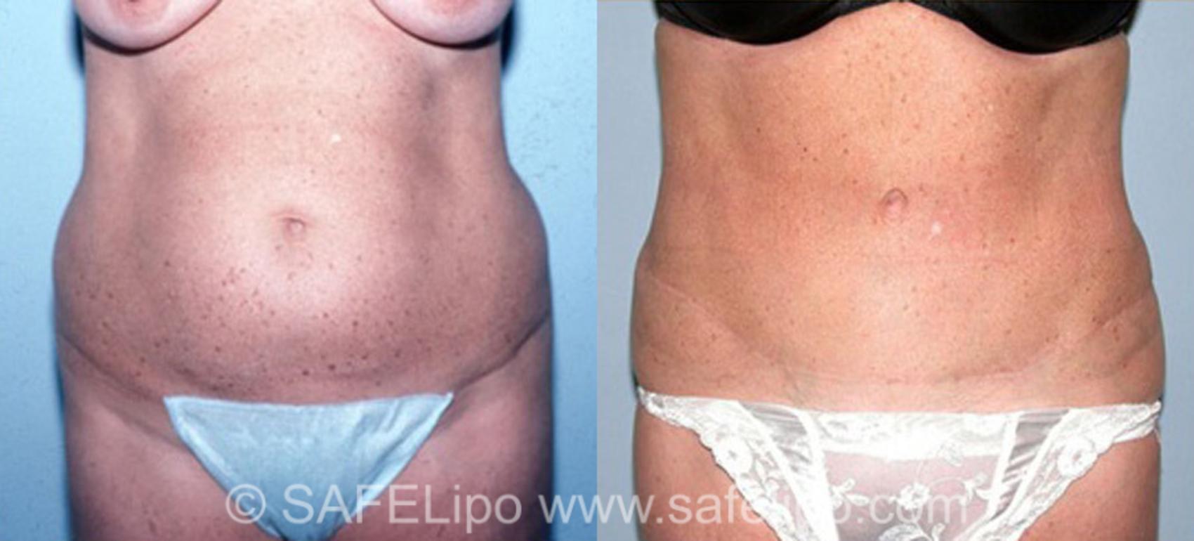Tummy Tuck Case 312 Before & After View #1 | SAFELipo®