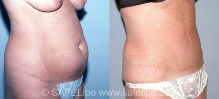 Tummy Tuck Case 312 Before & After View #2 | SAFELipo®