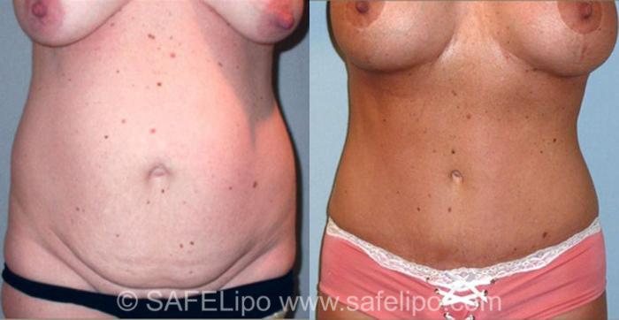 SAFELipoHD® Case 313 Before & After View #1 | SAFELipo®
