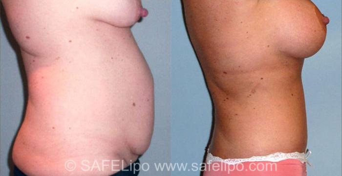 Tummy Tuck Case 313 Before & After View #2 | SAFELipo®