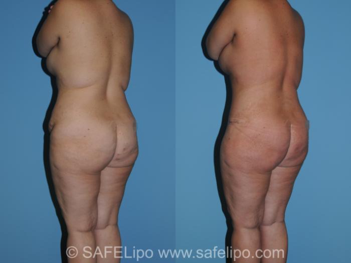 Abdominoplasty Back L Oblique Photo, Shreveport, LA, The Wall Center for Plastic Surgery, Case 314