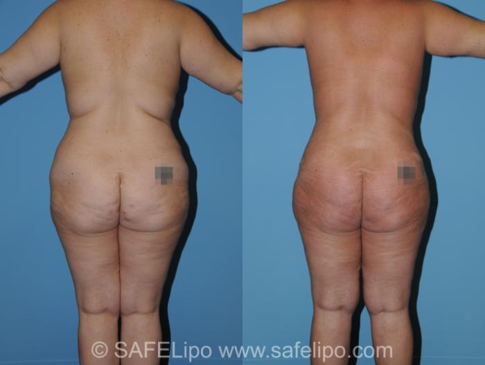 Abdominoplasty Back Photo, Shreveport, Louisiana, The Wall Center for Plastic Surgery, Case 314